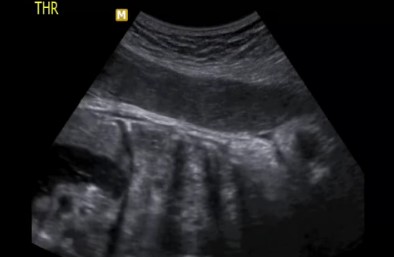 Diagnostico Prenatal de Hernia Diafragmatica Fetal en Nuestro Centro